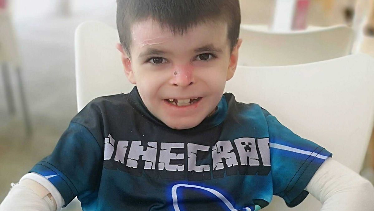 Leo, el niño sevillano que padece Piel de Mariposa