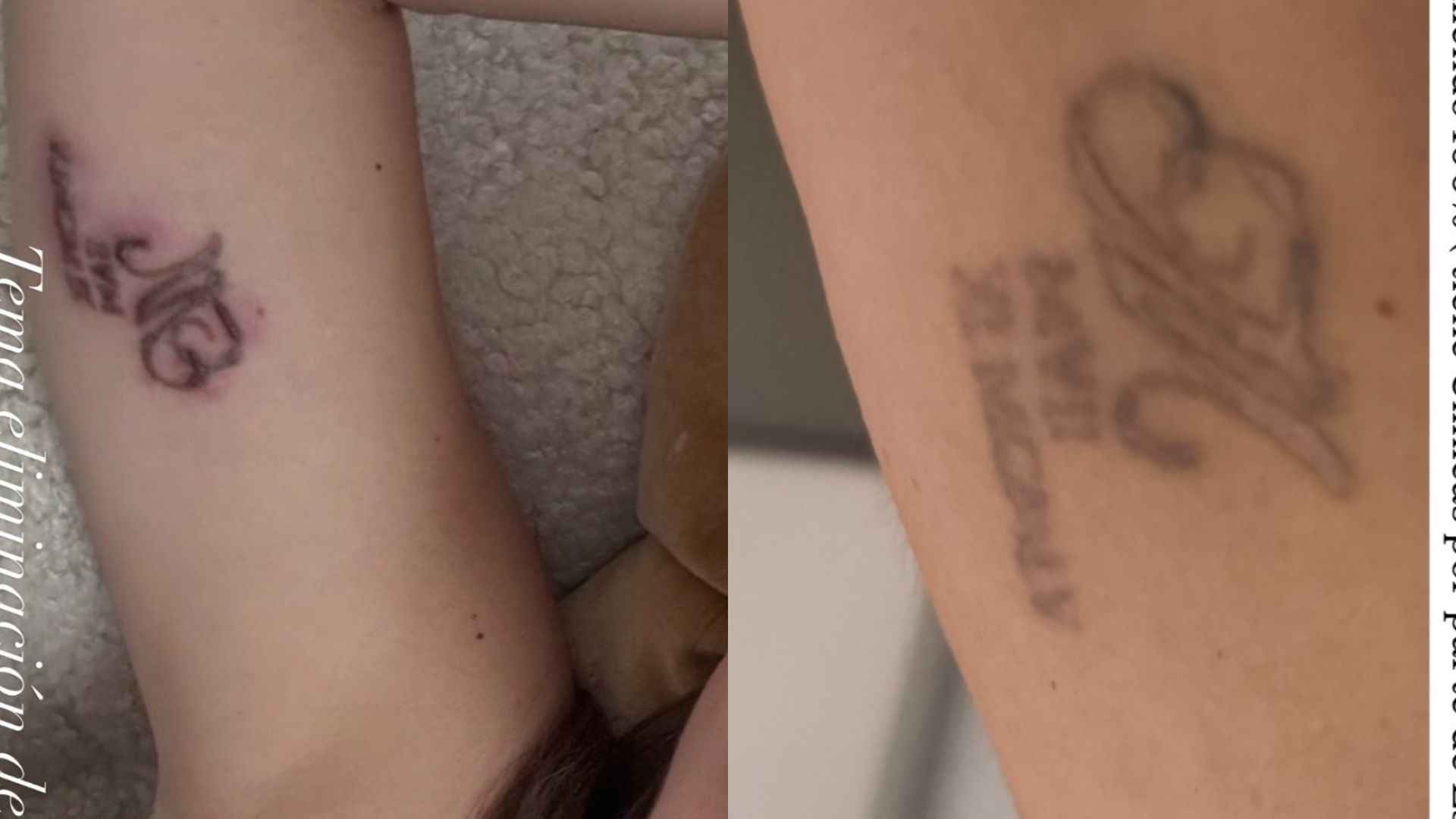 Melodie Peñalver muestra las graves secuelas que le dejaron en un procedimiento estético: "Se me hizo un queloide"