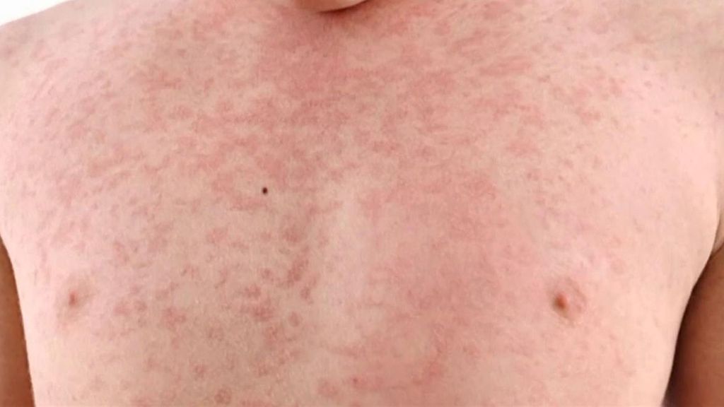 Por qué el sarampión vuelve a ser una enfermedad presente en España: más de la mitad de infectados no estaban vacunados