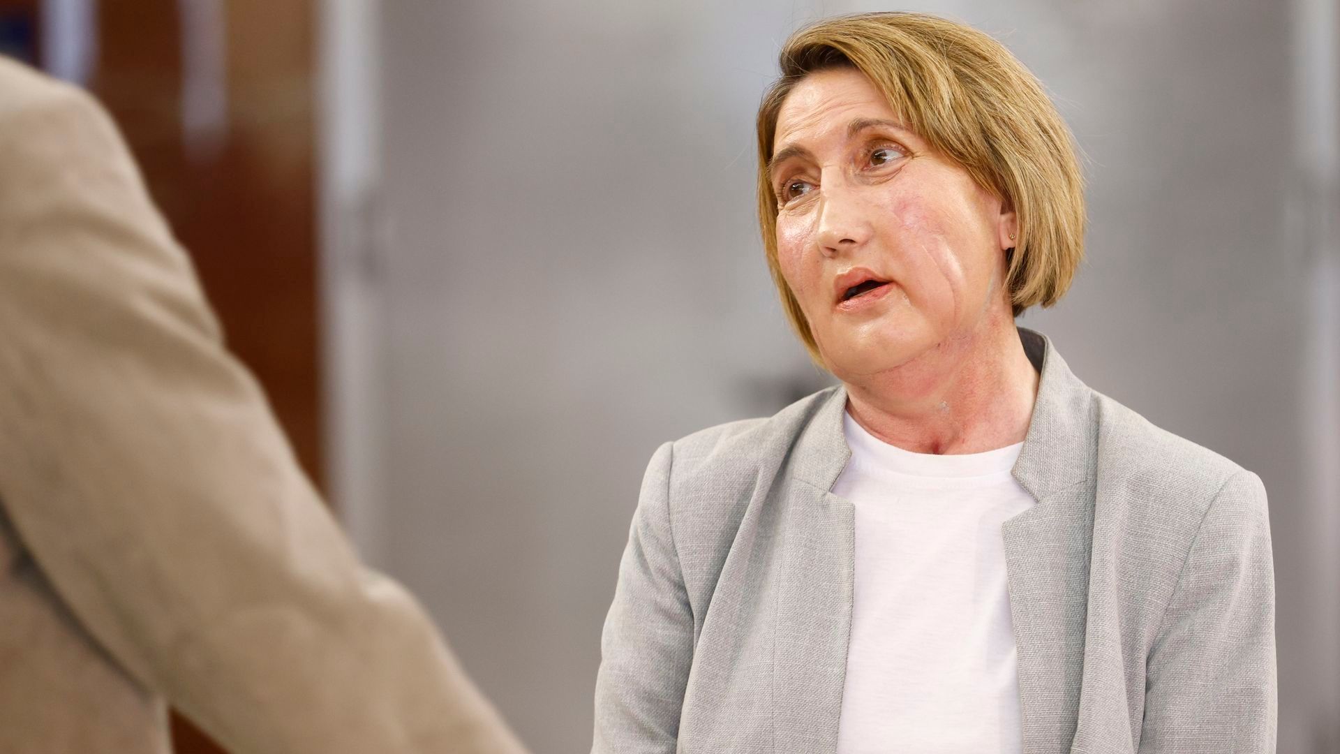 Carmen, la primera paciente en recibir un trasplante de cara de una donante que recibió una eutanasia