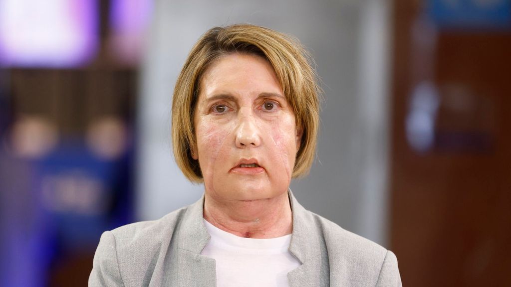 Carmen, la primera paciente en recibir un trasplante de cara de una donante que recibió una eutanasia