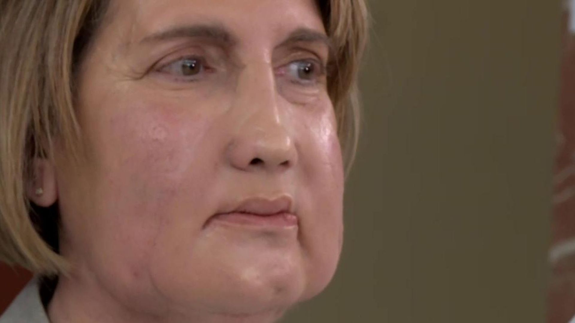 Trasplante de cara: Carmen ya puede volver a sonreír tras 20 horas, 100 médios y la eutanasia de su ángel de la guarda