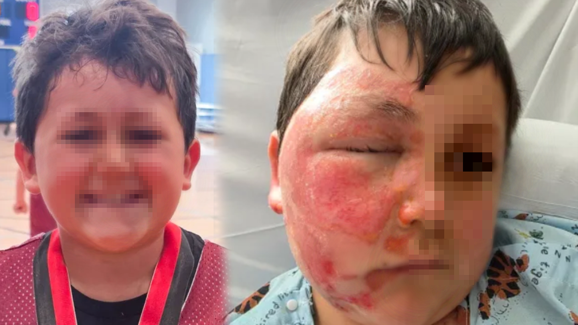 Las quemaduras que sufre un niño de nueve años tras realizar un reto viral de redes