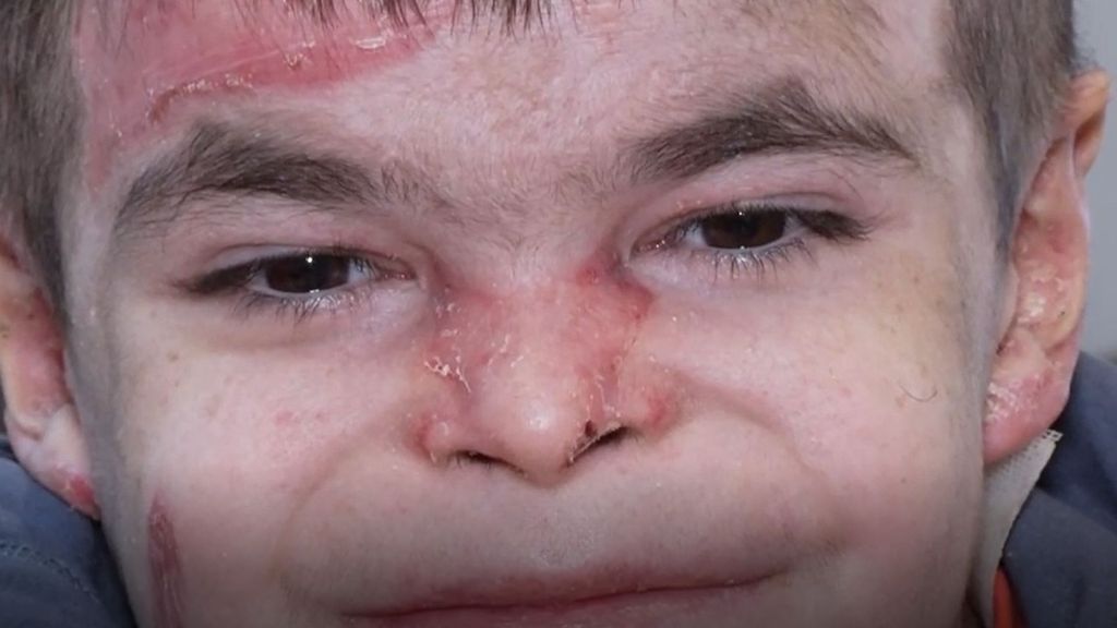 Leo, el niño con piel mariposa que necesita luz verde a la medicina para vivir sin dolor: "La gente me mira con asco"