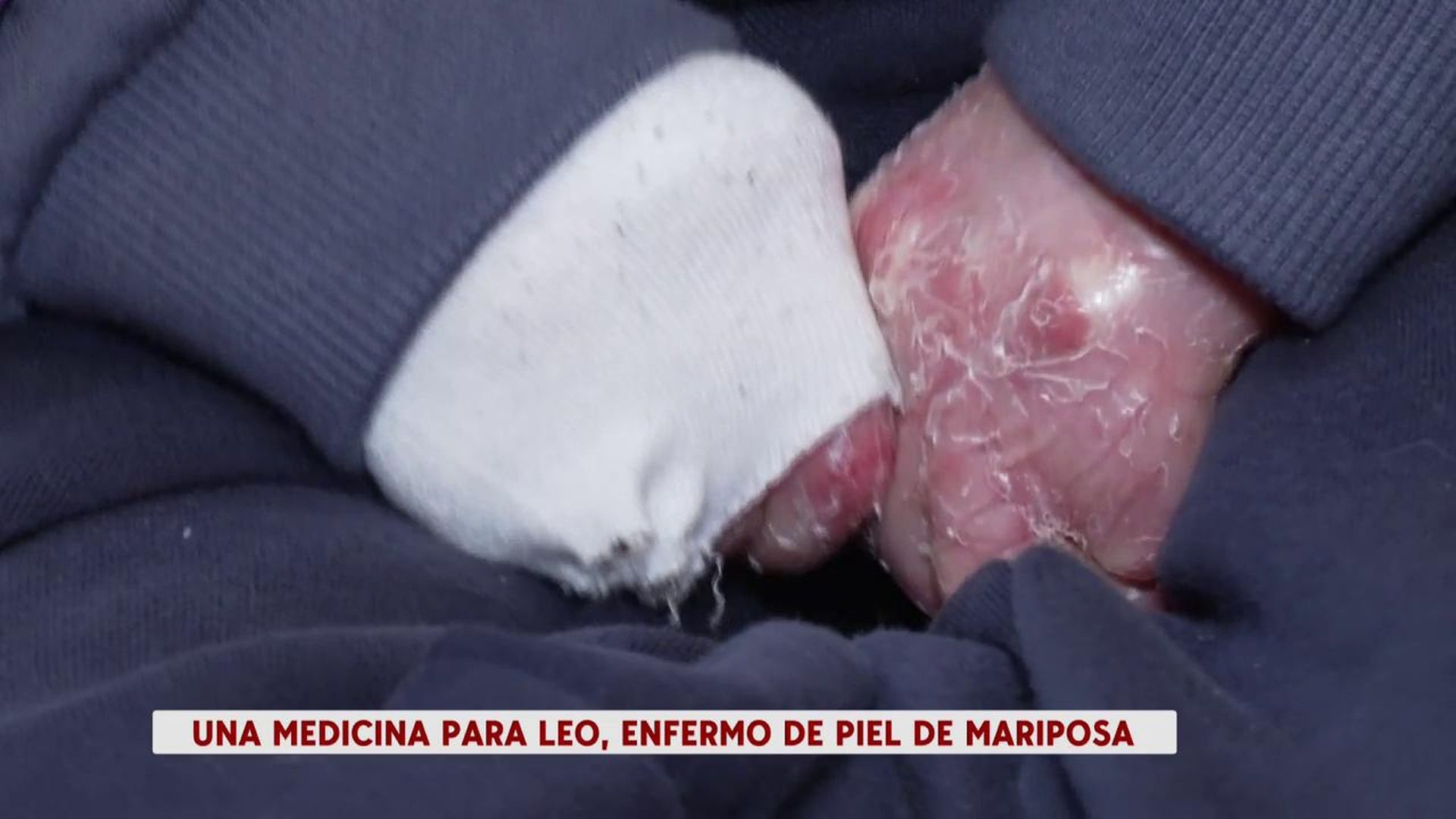 Las manitas de Leo, lleno de heridas por su piel de mariposa