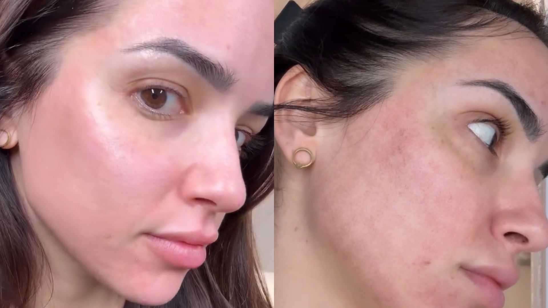 Lucía Sánchez se somete a un láser CO2: qué es y en qué consiste