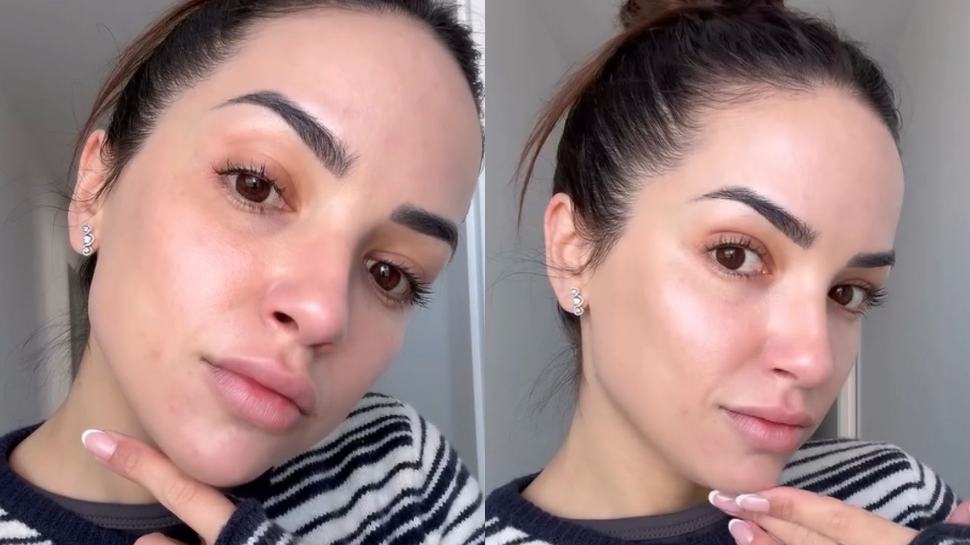 Lucía Sánchez se somete a un láser CO2: qué es y en qué consiste