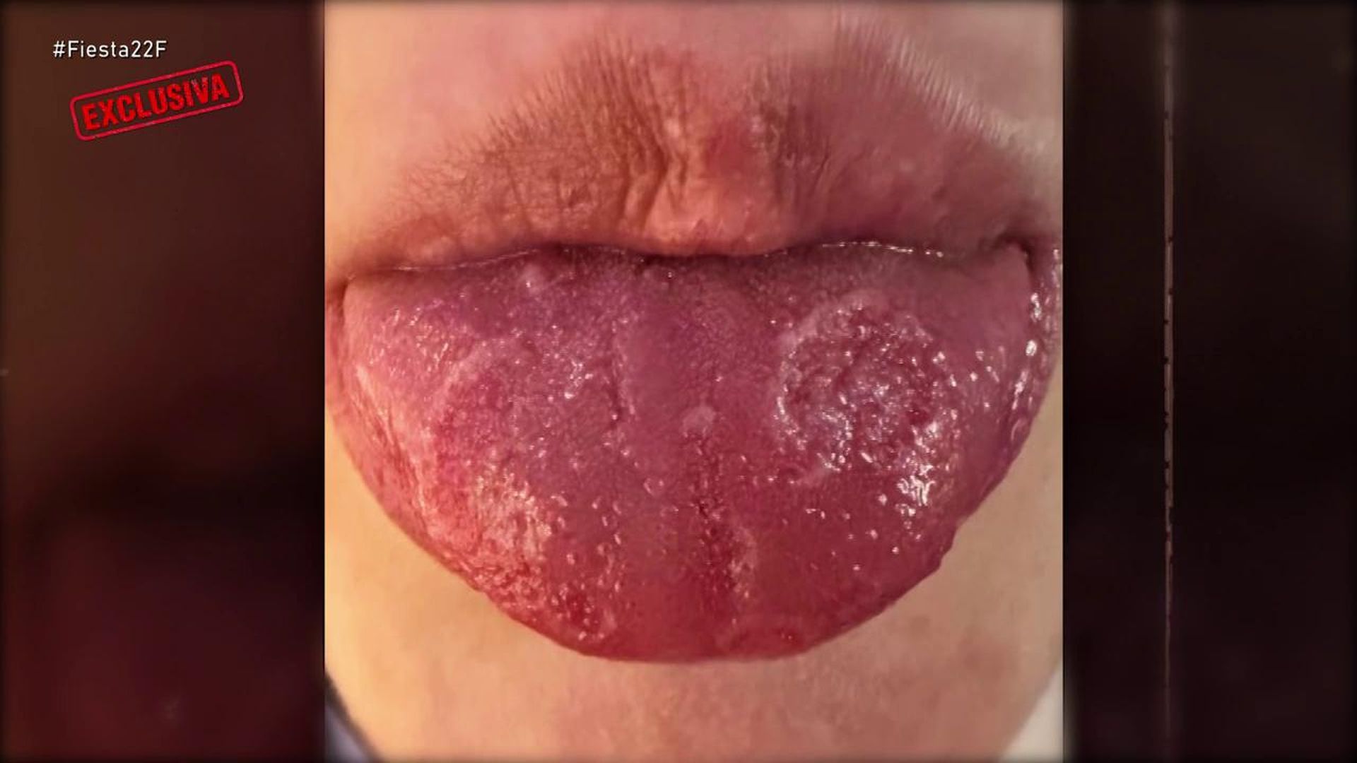 Las lesiones en la lengua tras ser agredido con un spray de pimienta