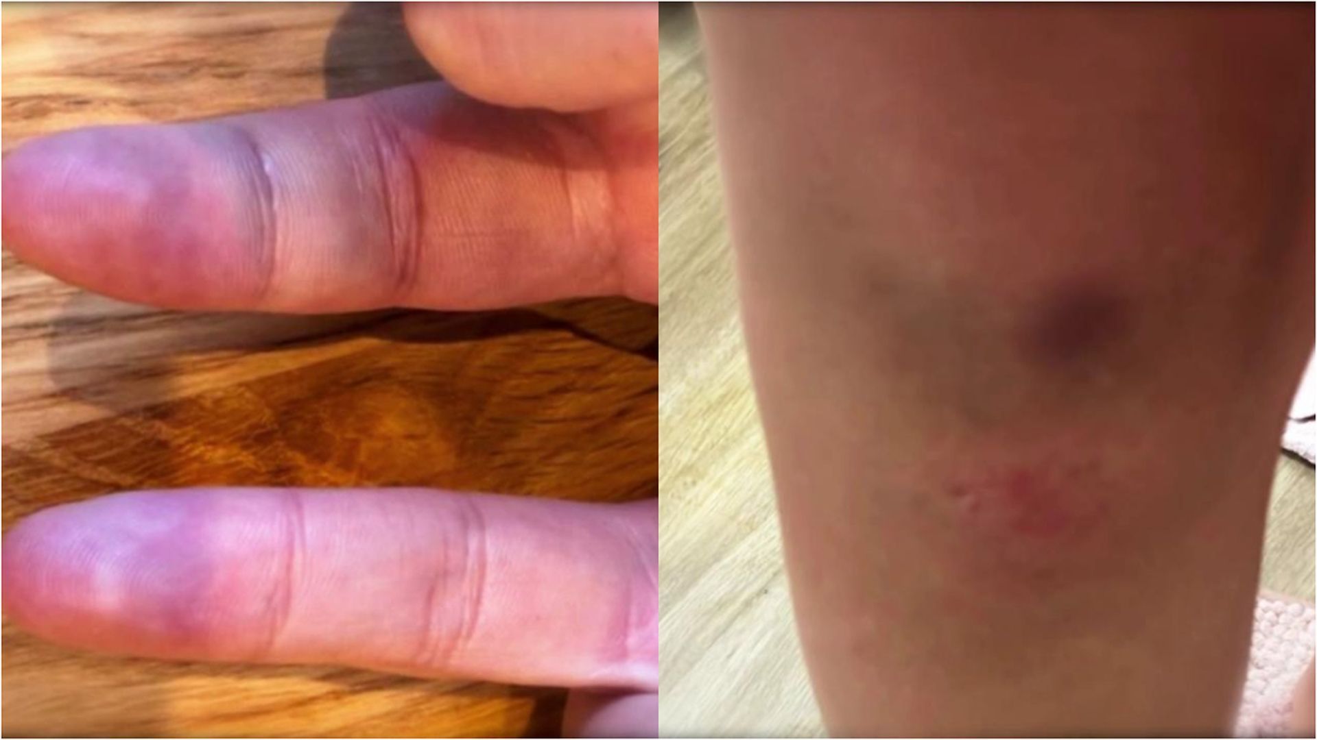 Los hematomas en dedos y piernas