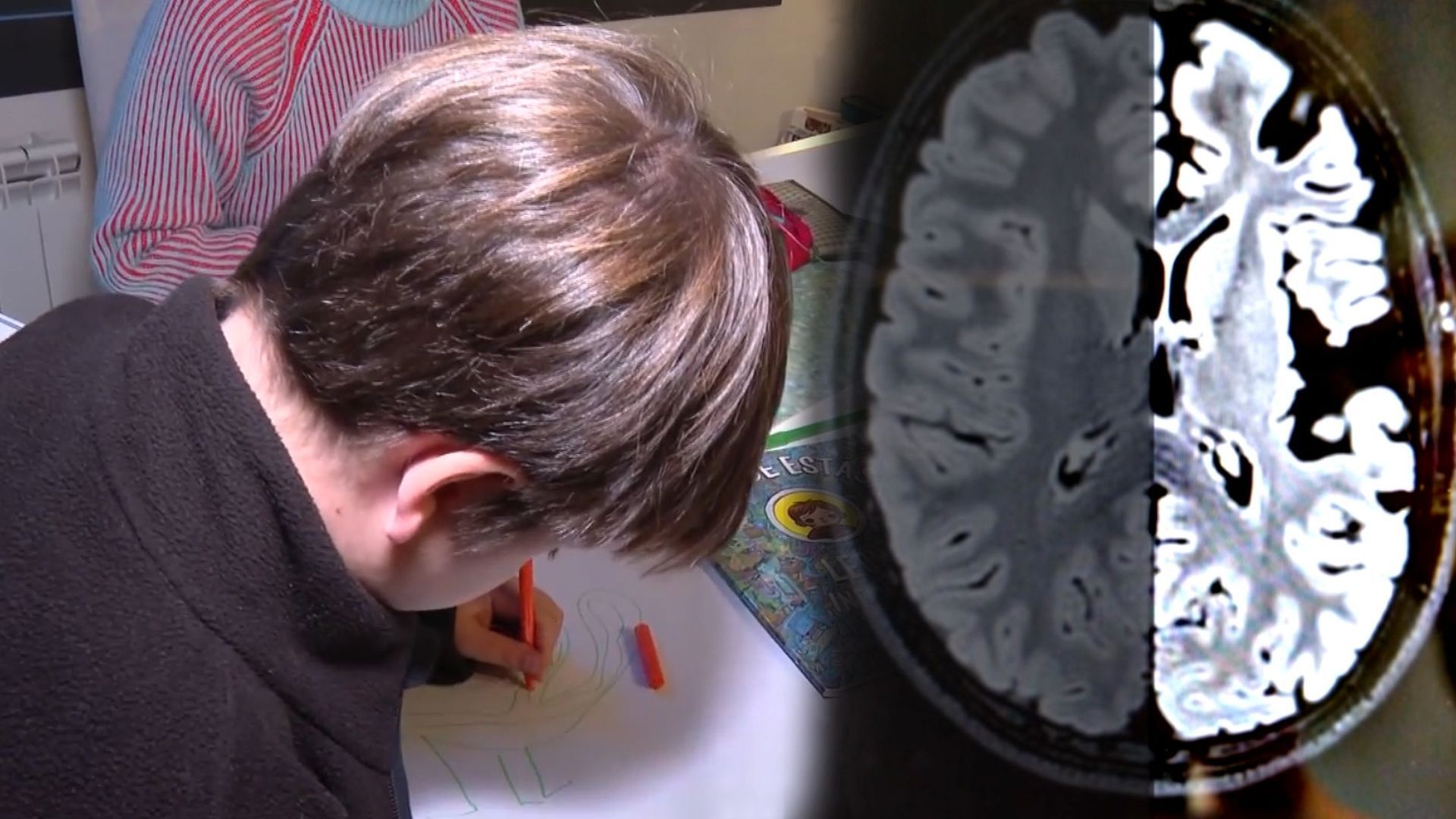 El niño que vive con medio cerebro desconectado para evitar la epilepsia: "La cirujía aisla el hemisferio e impide que se dañe a niño" El niño que vive con medio cerebro desconectado para evitar la epilepsia: "La cirujía aisla el hemisferio e impide que se dañe a niño"