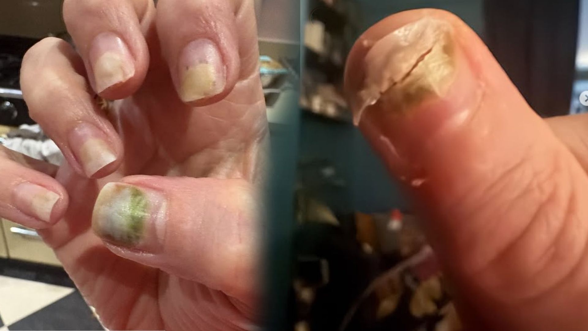 Muestra paso a paso cómo su uñas se cayeron.