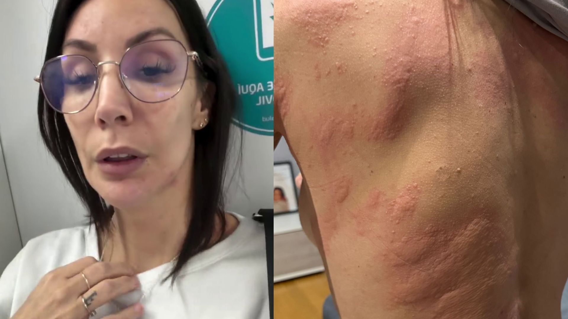 Las imágenes de Fani Carbajo en urgencias, con una tremenda reacción alérgica