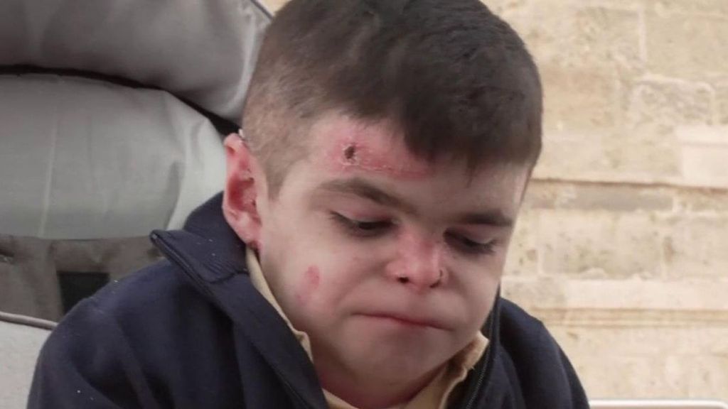 La Junta pagará a Leo su medicamento para paliar el dolor de su piel de mariposa: "Una alegría que lo flipas"