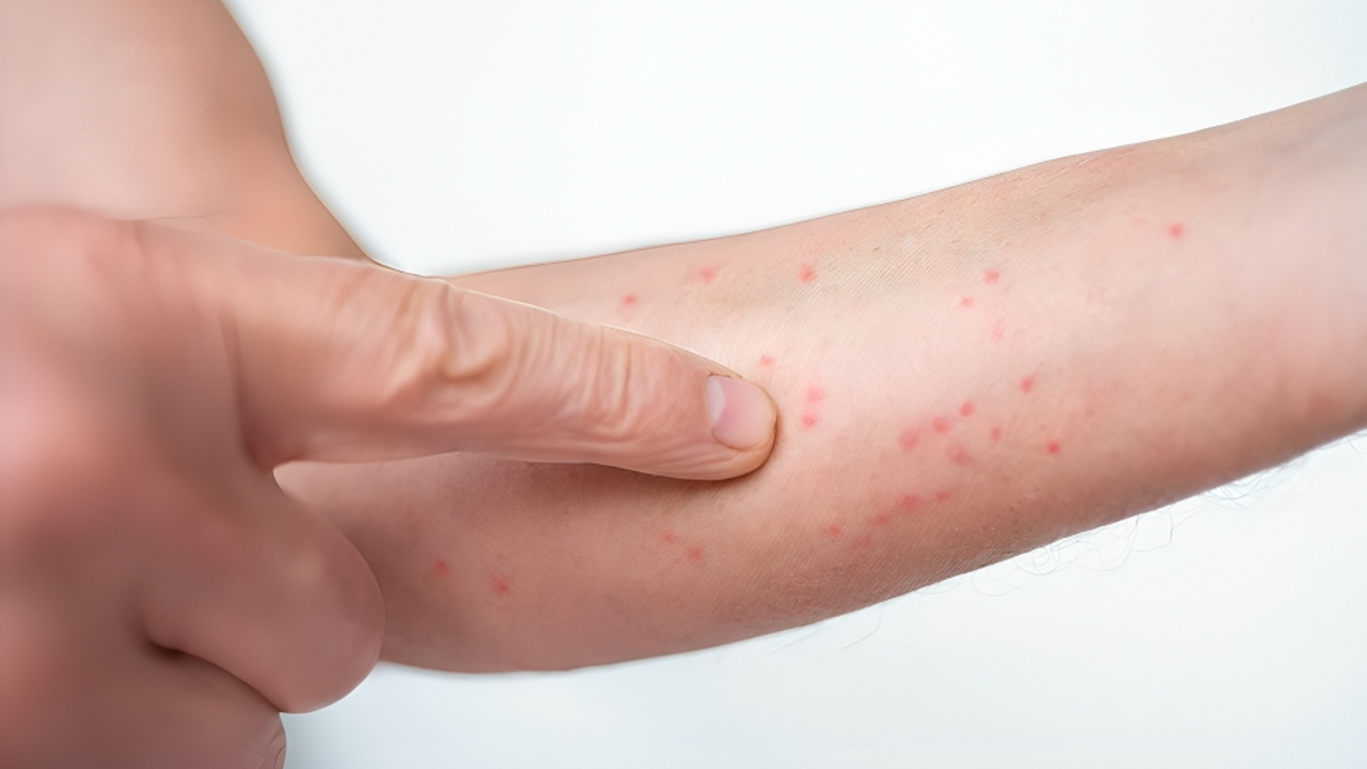 Persona con sarna Persona con sarna