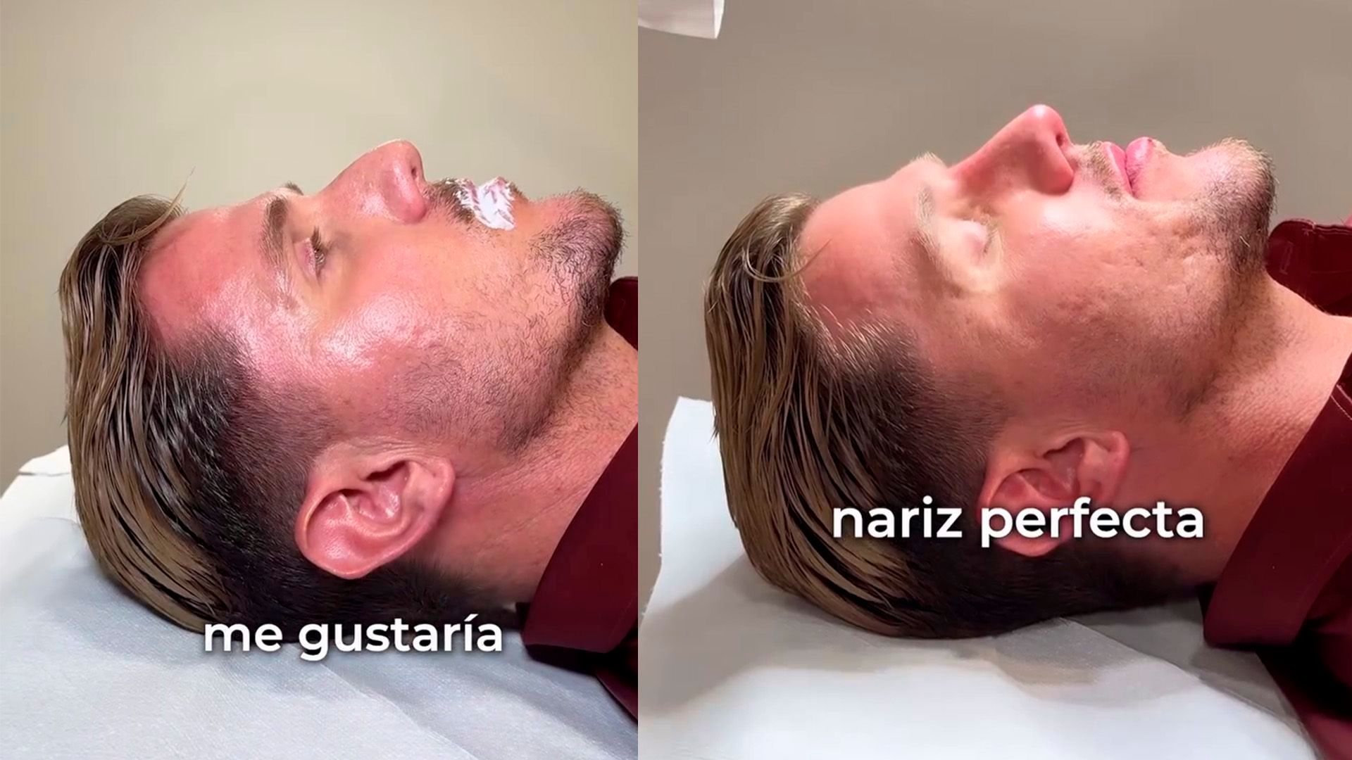 El antes y después de la nariz de Tadeo Corrales