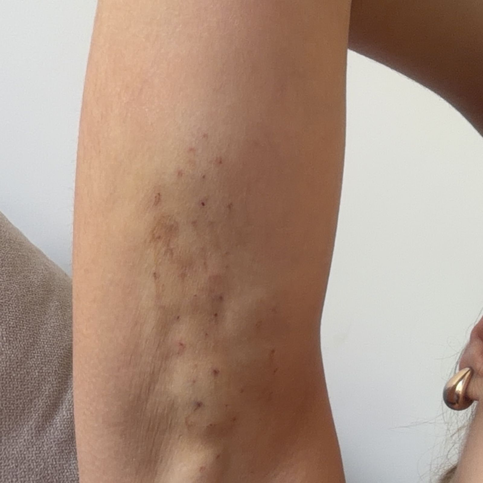 El brazo de Ivana Icardi tras pincharse enzimas