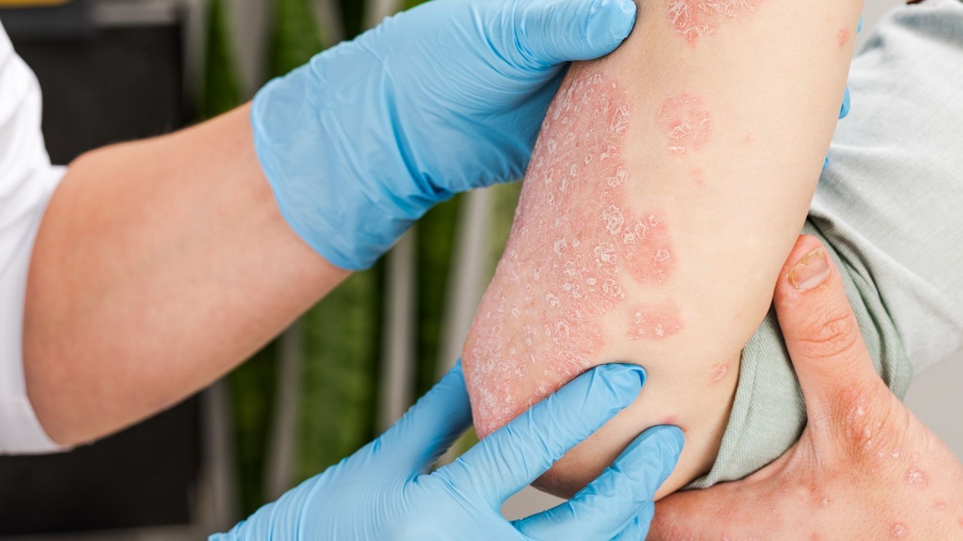 Se decubre que el fármaco 'dasatinib' puede mejorar la psoriasis Se decubre que el fármaco 'dasatinib' puede mejorar la psoriasis
