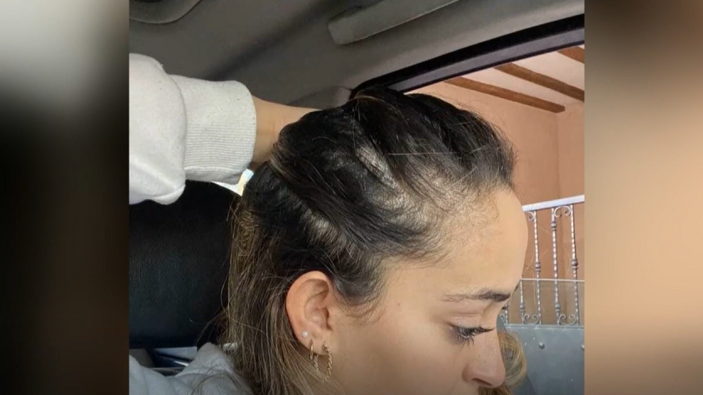 El peinado viral que está provocando caída de pelo entre jóvenes