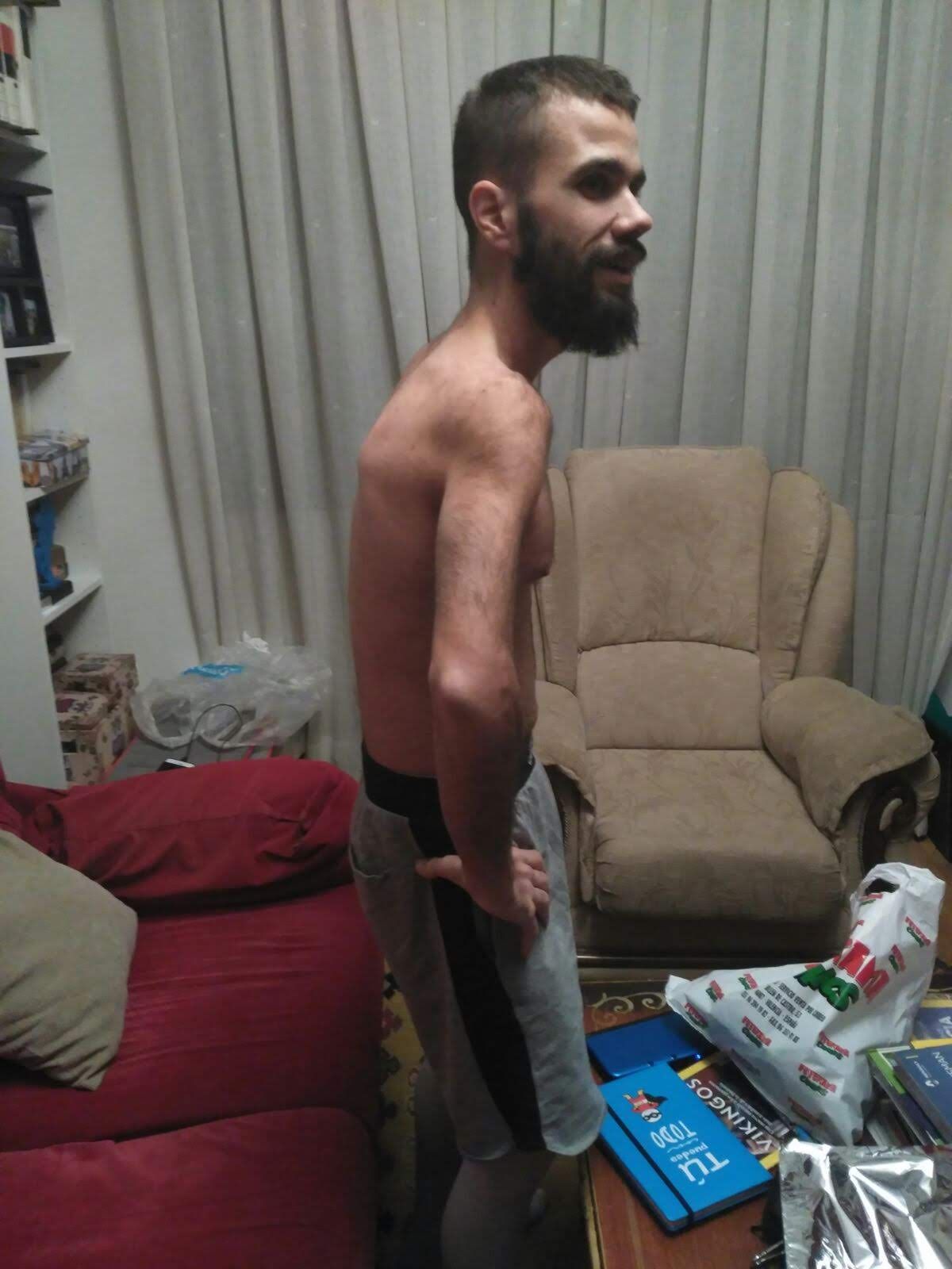 Gonzalo llegó a pesar 47 kilos tras someterse a operaciones y tratamientos