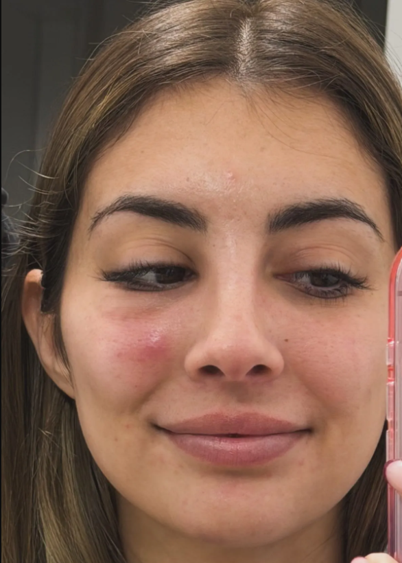 Marieta durante su primer episodio de celulitis facial