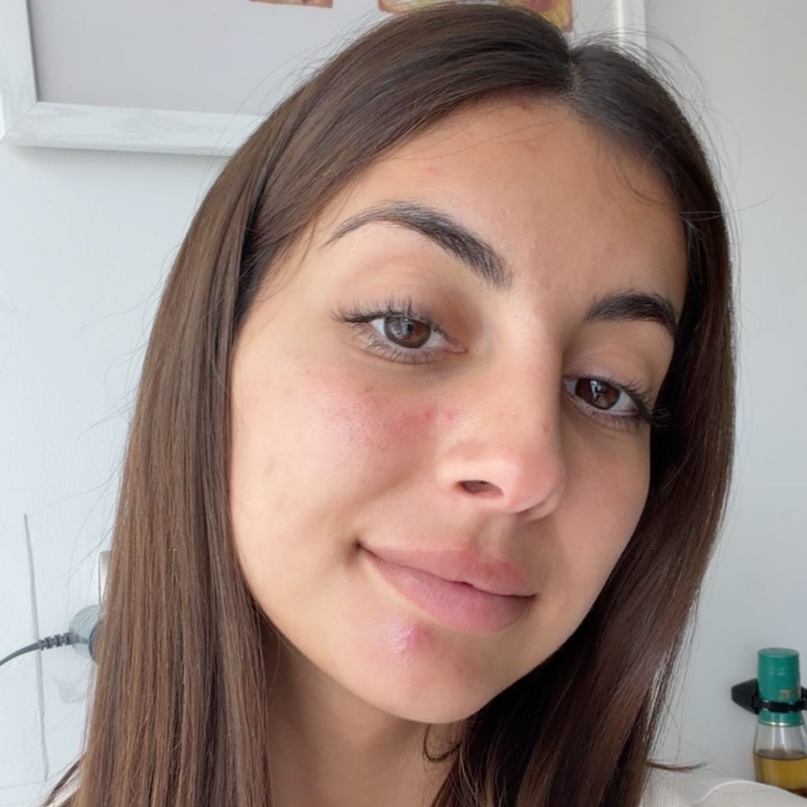 Marieta durante su segundo brote de celulitis facial