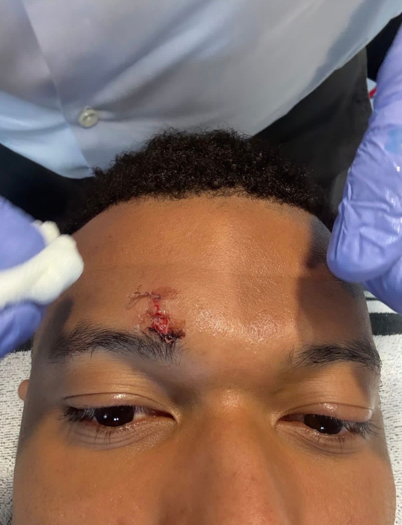 La herida de Kylian Mbappé tras el Real Madrid-Girona