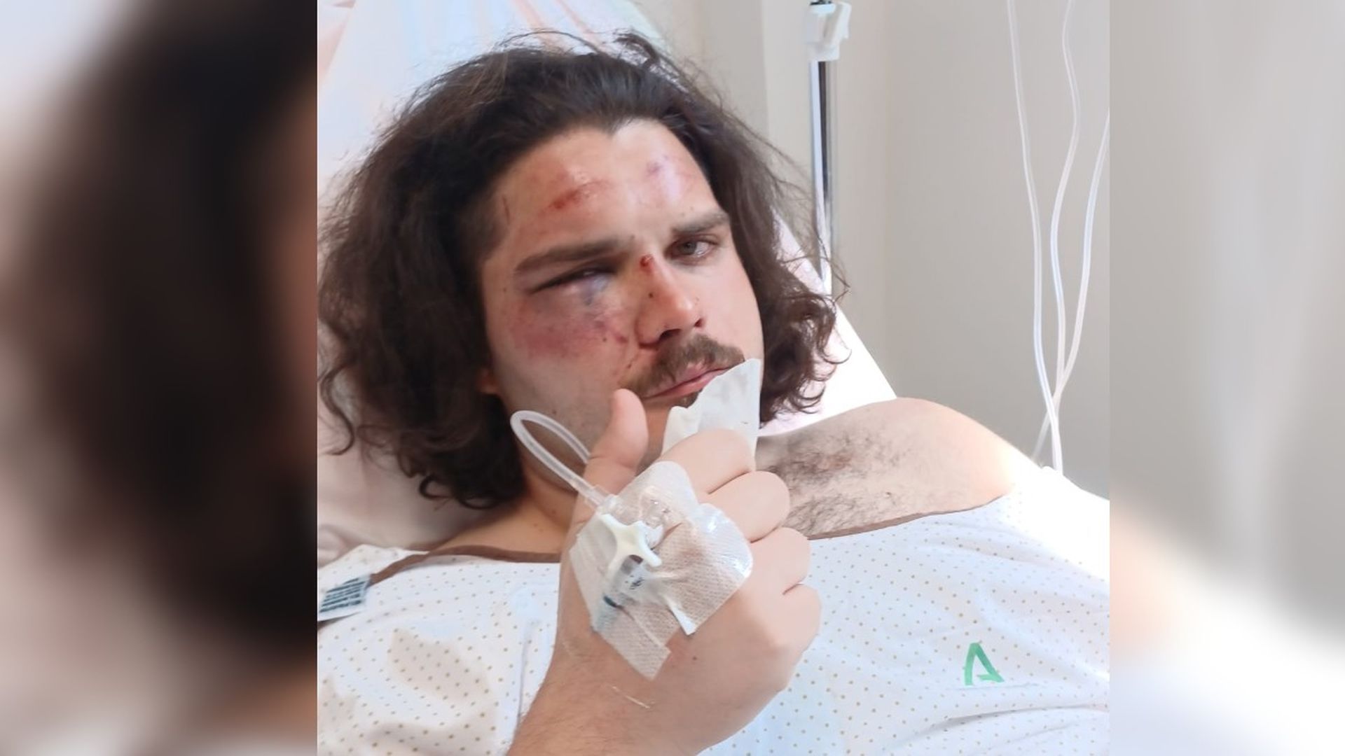 Roberto continúa con su recuperación tras la agresión sufrida en las fiestas de La Herradura, Granada Roberto continúa con su recuperación tras la agresión sufrida en las fiestas de La Herradura, Granada