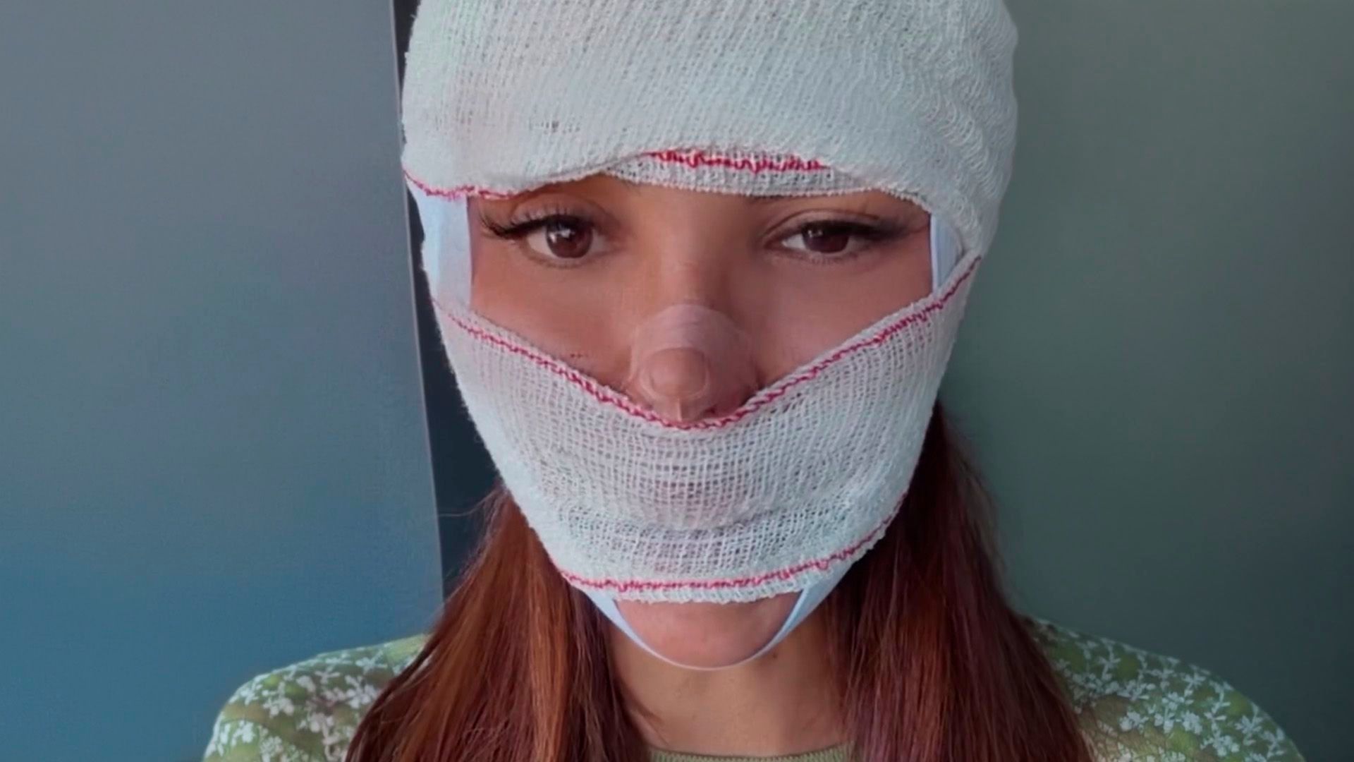 Telecinco Cristini Couto reaparece con toda la cara vendada y explica el motivo