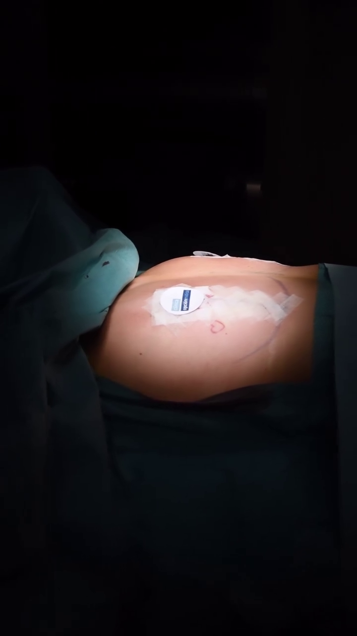 El resultado de la retirada de implantes mamarios