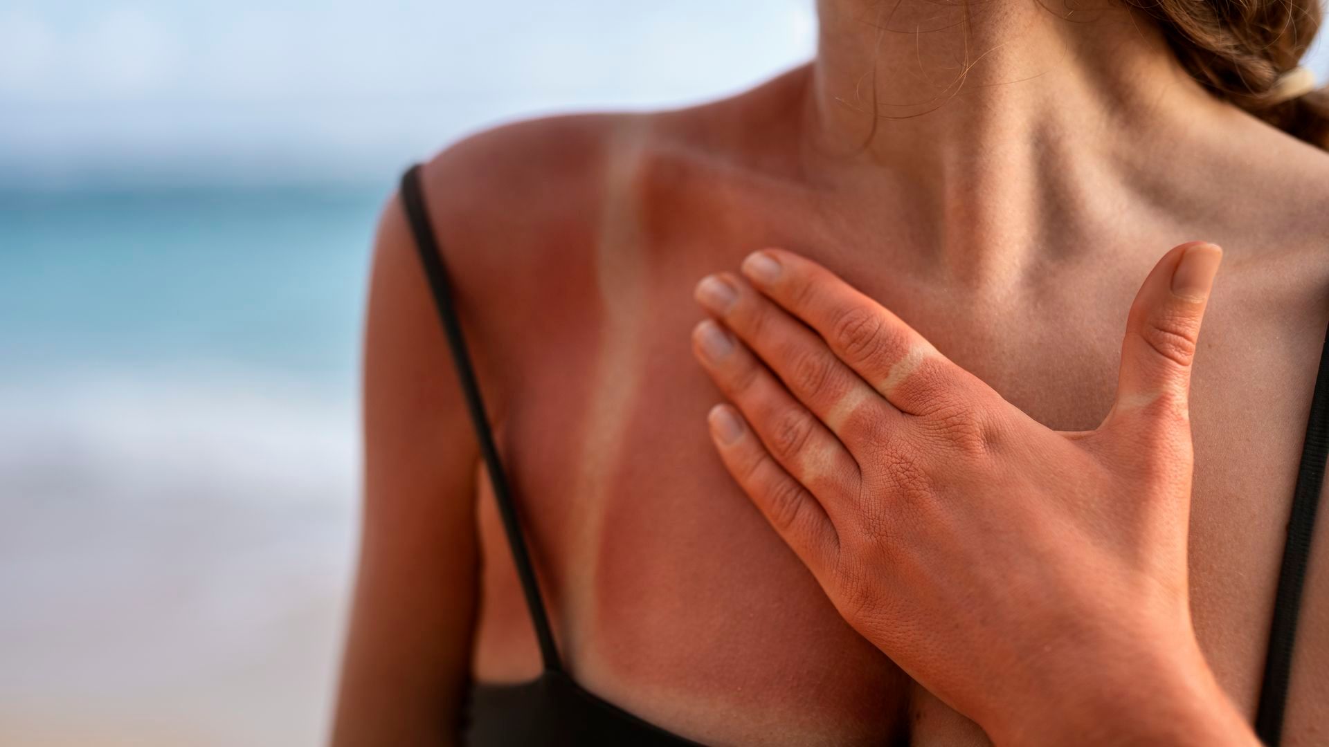 Una mujer quemada por el sol Una mujer quemada por el sol