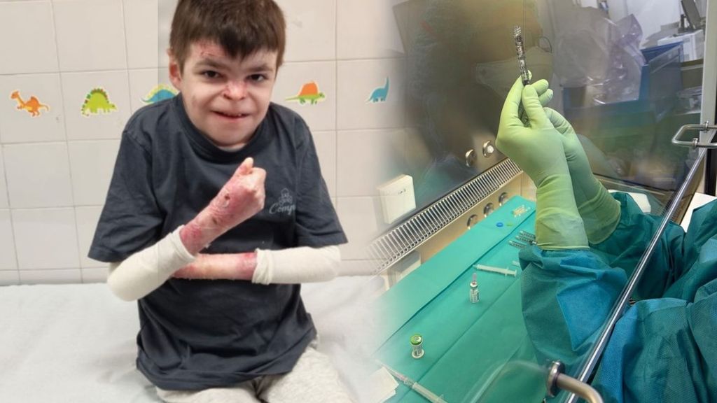 Leo, el niño con piel de mariposa, acude al hospital para recibir la primera dosis del tratamiento