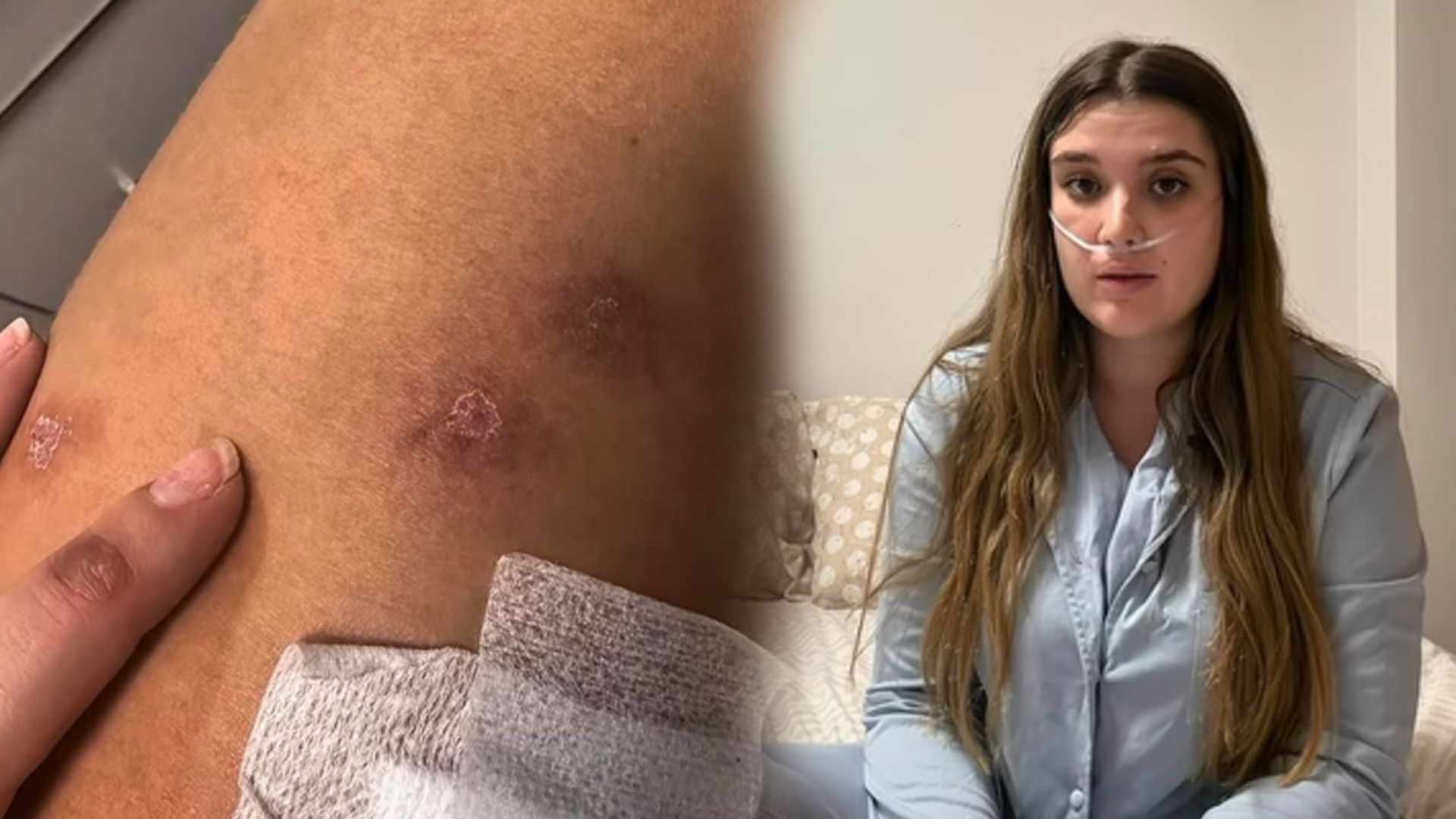 La situación crítica de Cristina Romaña, ingresada en una UCI de Alemania por picaduras de garrapata y comer carne cruda: "Solo empeora"