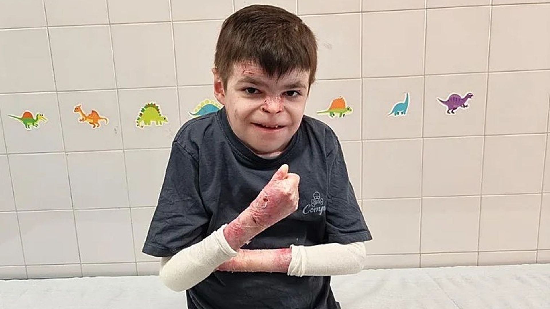 Leo, el niño sevillista que ya recibe su tratamiento para la piel de mariposa