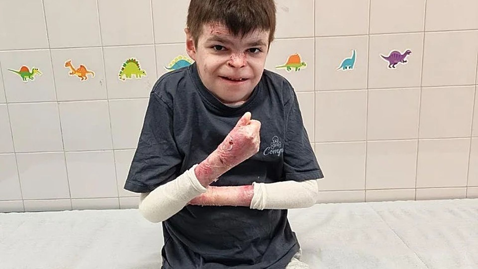 Leo, el niño sevillista que ya recibe su tratamiento para la piel de mariposa