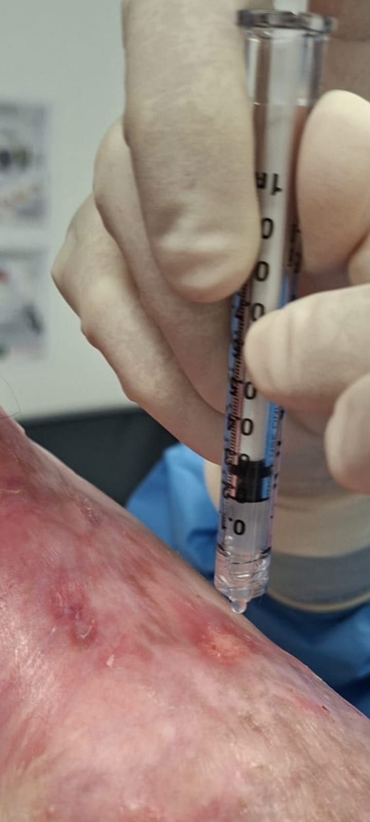 Medicamento para la Piel de mariposa