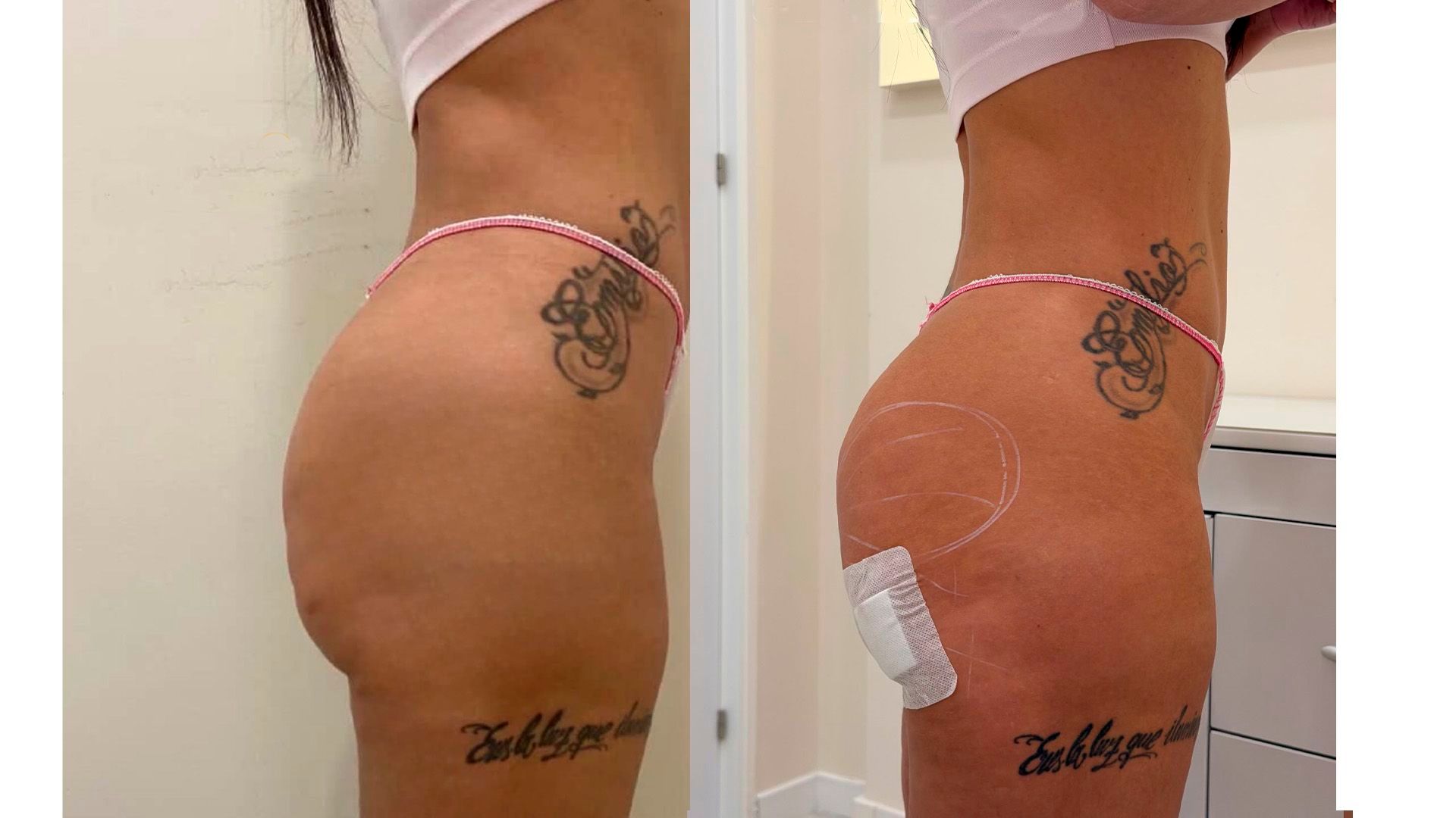 El antes y después del glúteo de Fani Carbajo