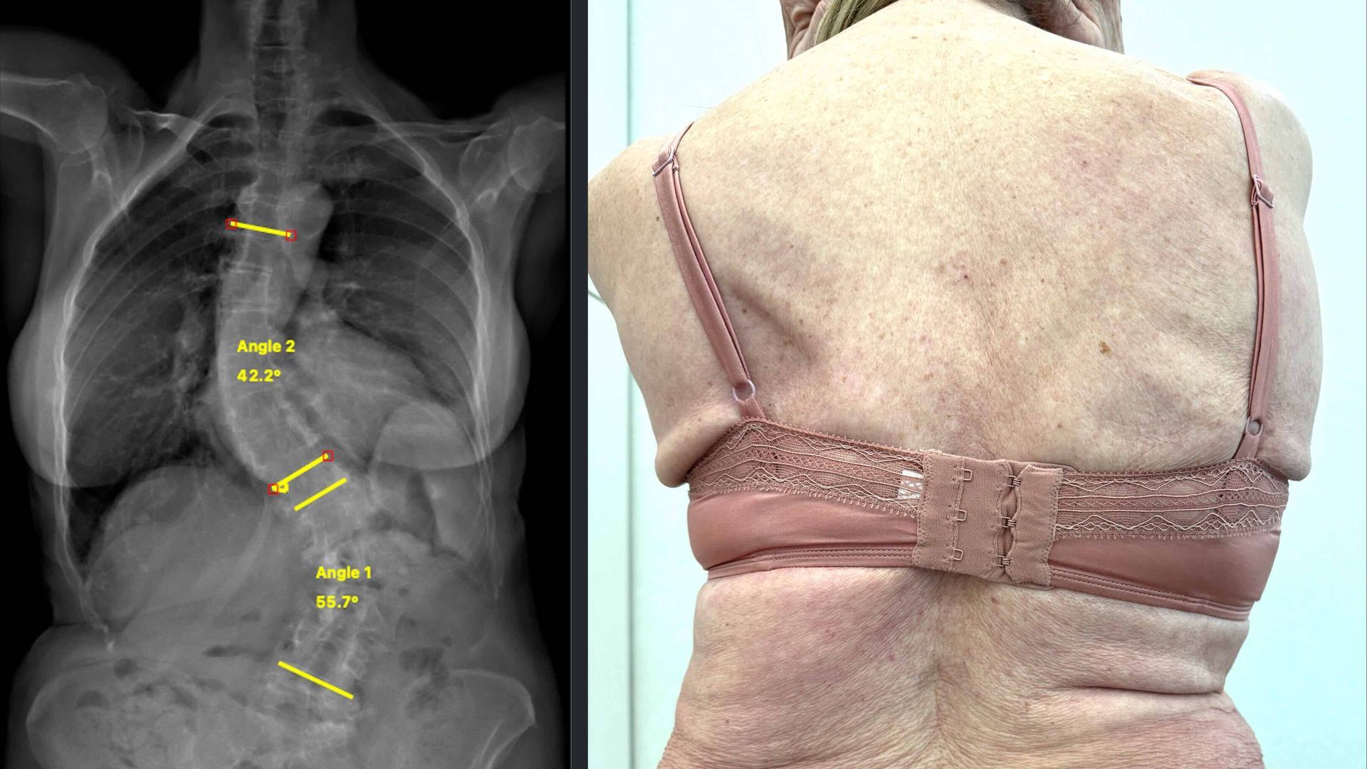 La paciente tenía una curvatura lumbar y dorsal
