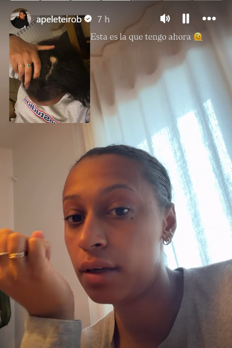 Ana Peleteiro enseña su calva en el pelo