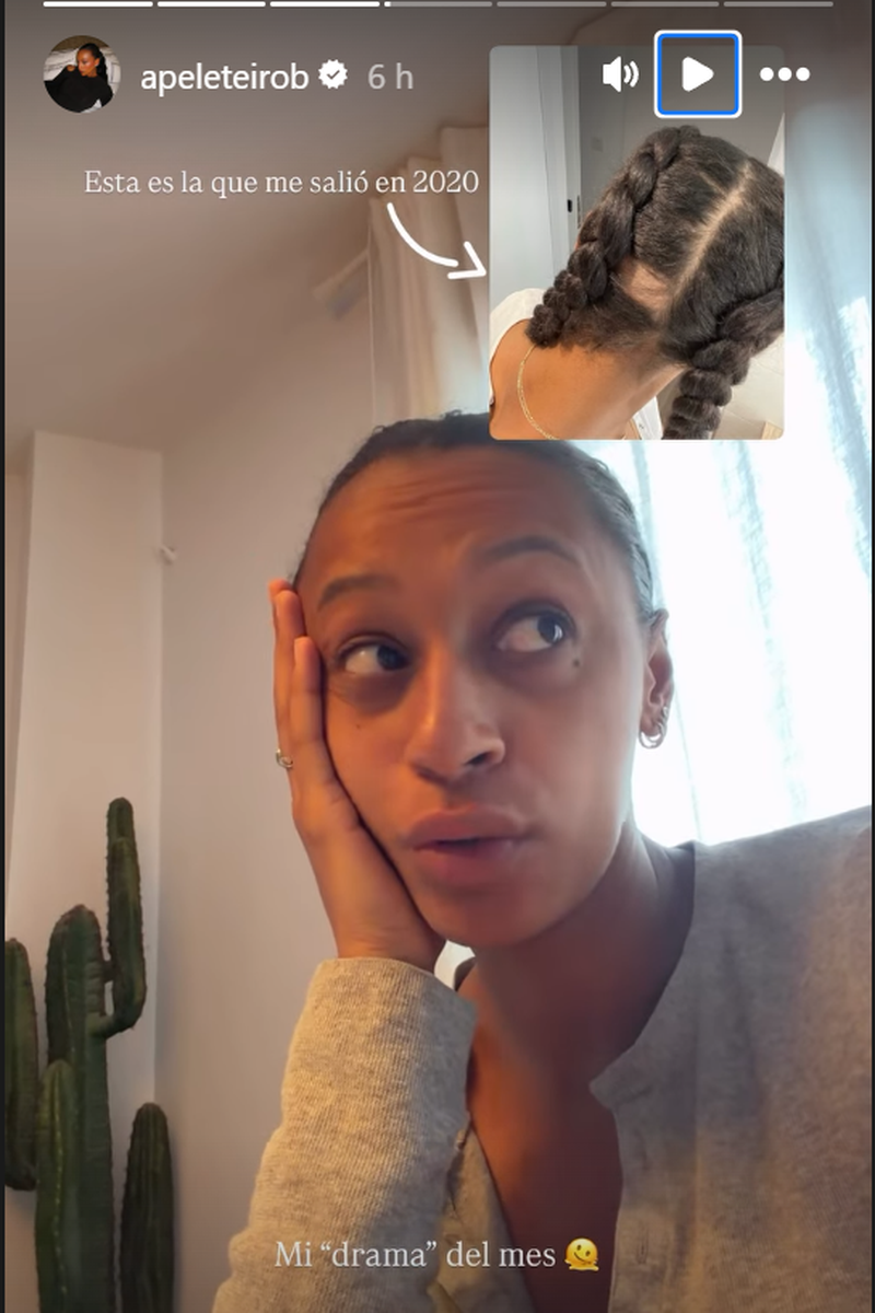 Ana Peleteiro enseñpa su calva de hace años