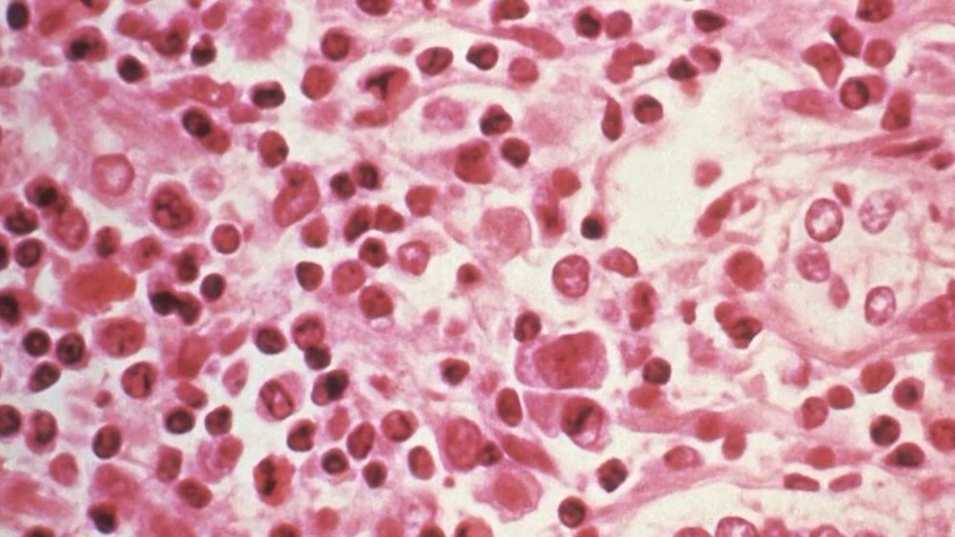 La señal de alerta del hantavirus: la tos seca anticipa la fase más crítica