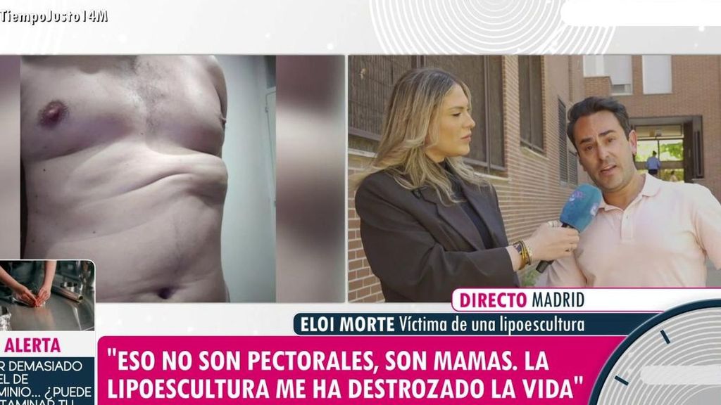 La pesadilla de Eloy tras una mala praxis en su lipoescultura: con dolor crónico y una "pelota de tenis" bajo el pectoral tres años después