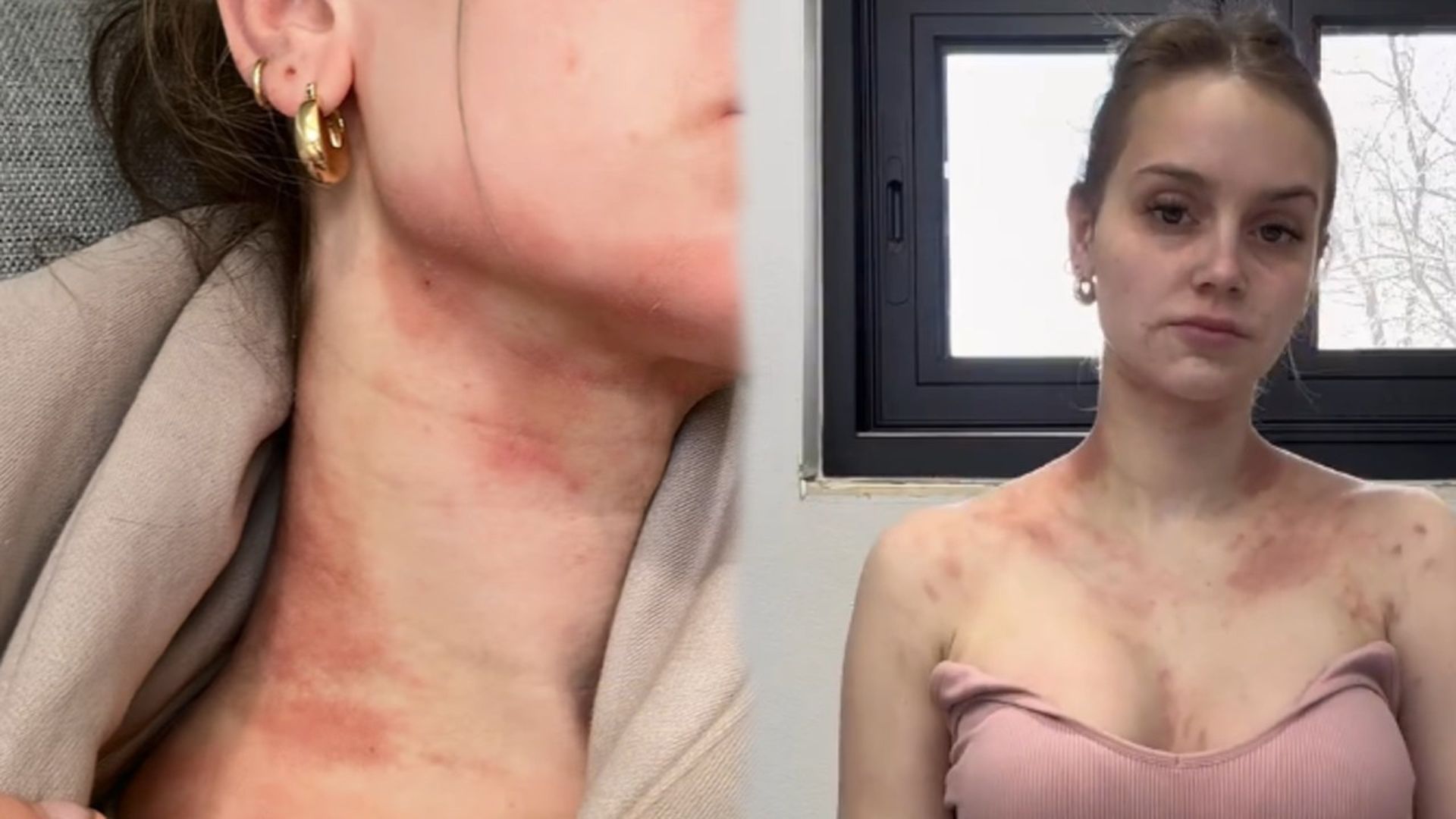 La influencer Mikayla Matthews responde a las críticas por su problema de piel: "Puede quitarte las ganas de vivir" La influencer Mikayla Matthews responde a las críticas por su problema de piel: "Puede quitarte las ganas de vivir"