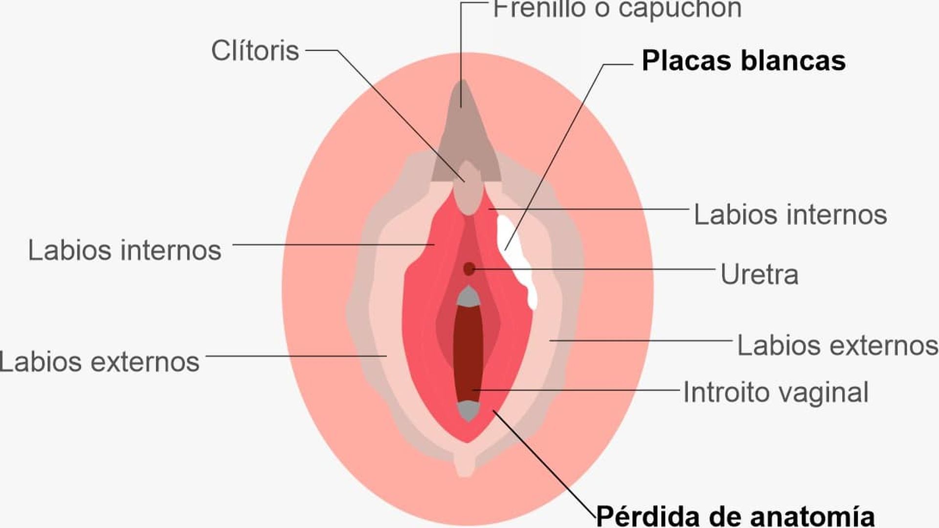 Ilustración sobre los efectos del liquen escleroso vulvar