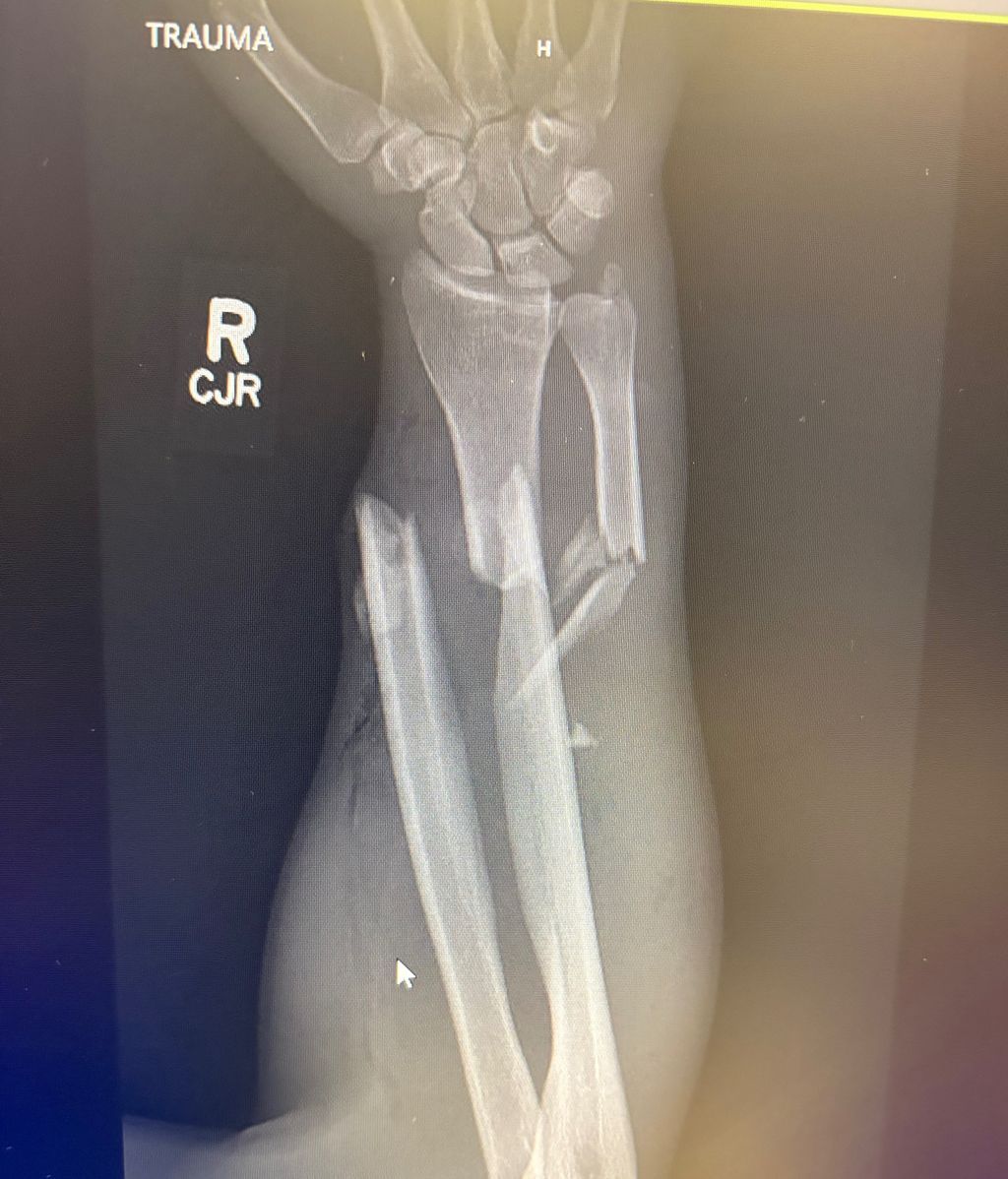 El brazo de Daniel tras el ataque del oso