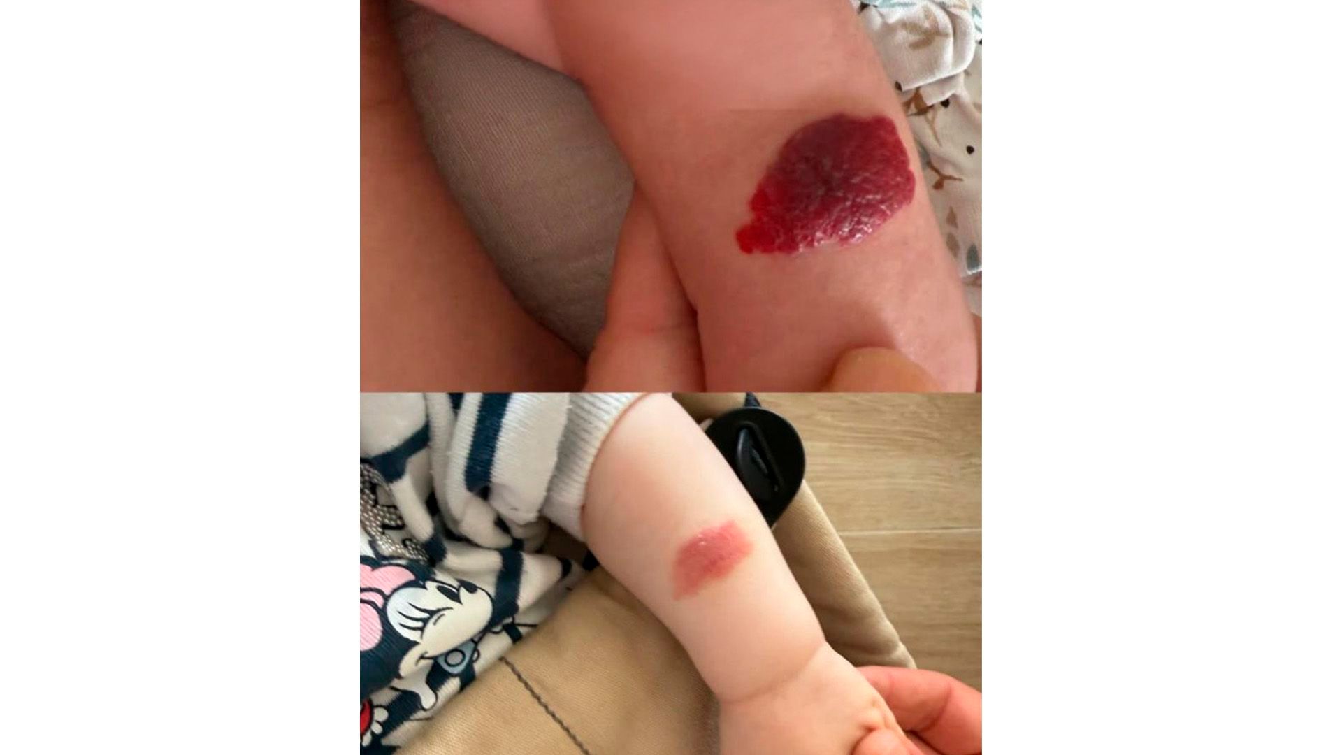 La evolución del hemangioma de Cala, la hija de Lester y Patri