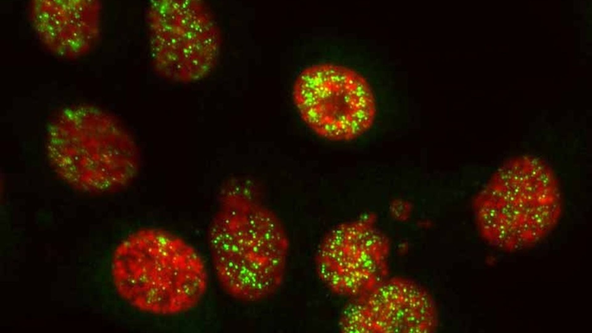 Células de cáncer de páncreas con ADN (rojo) y con la proteína cGAS (verde), un sensor del sistema inmunitario