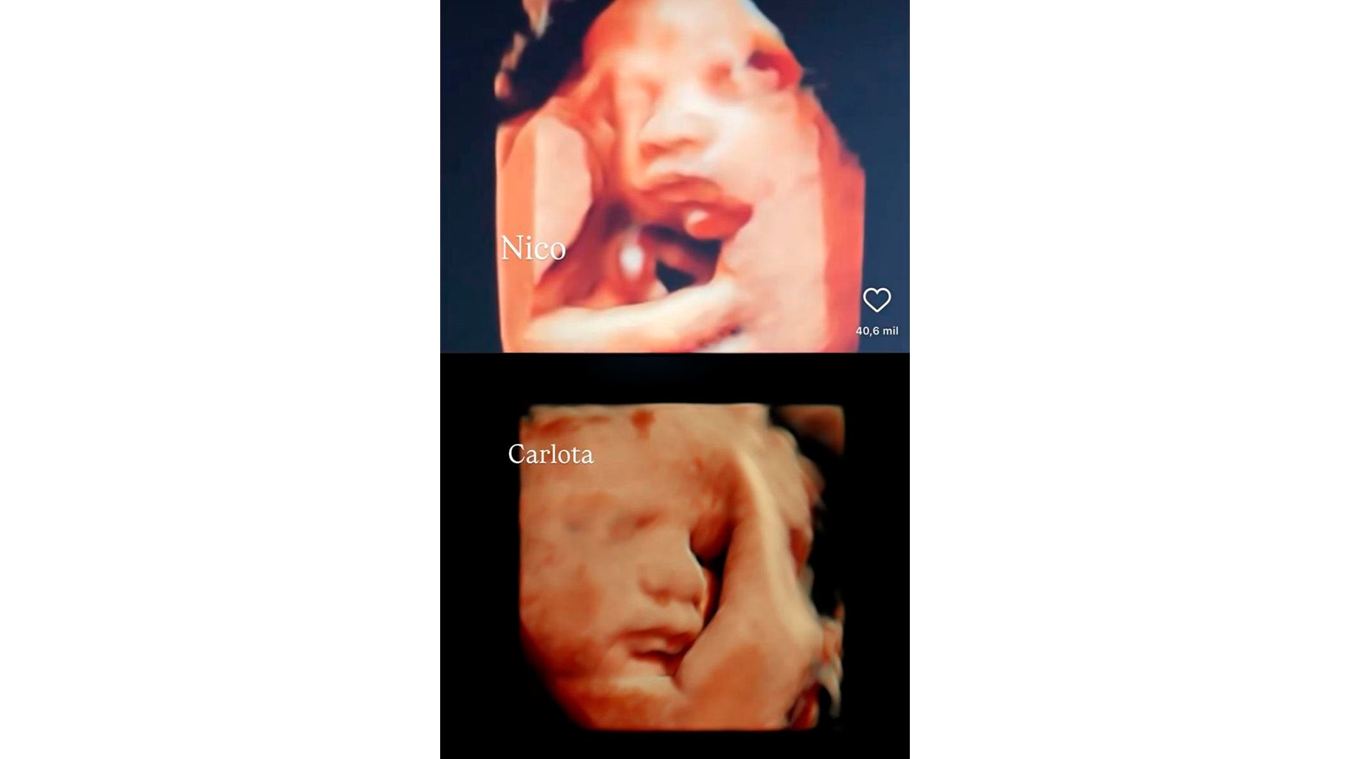 Las dos ecografía 5D de los hijos de Lara Tronti