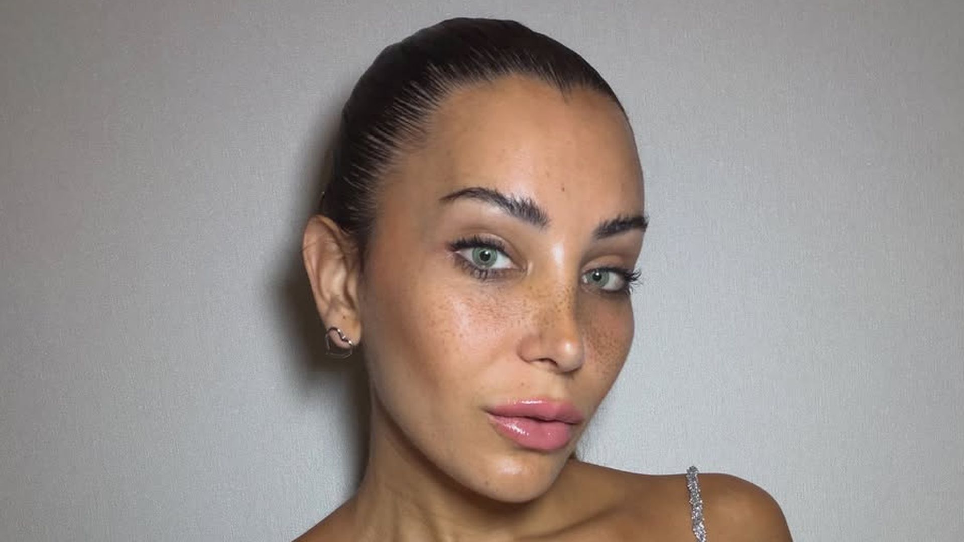 Daniela Requena enseña las impactantes imágenes de las secuelas que le dejó su segunda liposucción Daniela Requena enseña las impactantes imágenes de las secuelas que le dejó su segunda liposucción