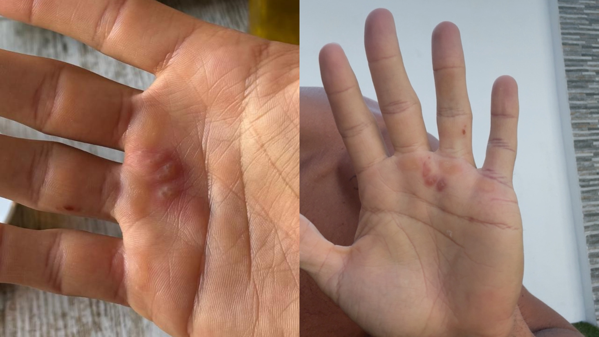 Las heridas de la mano de Iván González