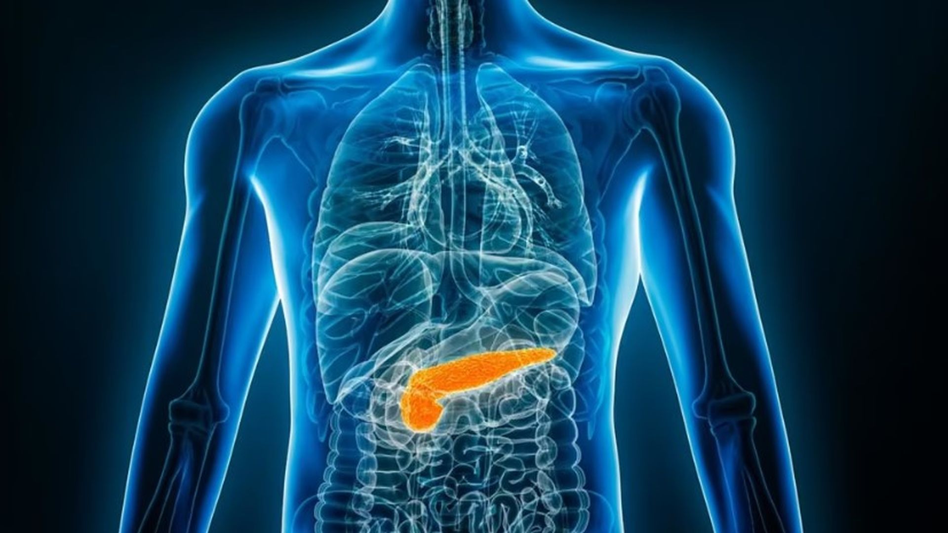 Cáncer de páncreas Cáncer de páncreas